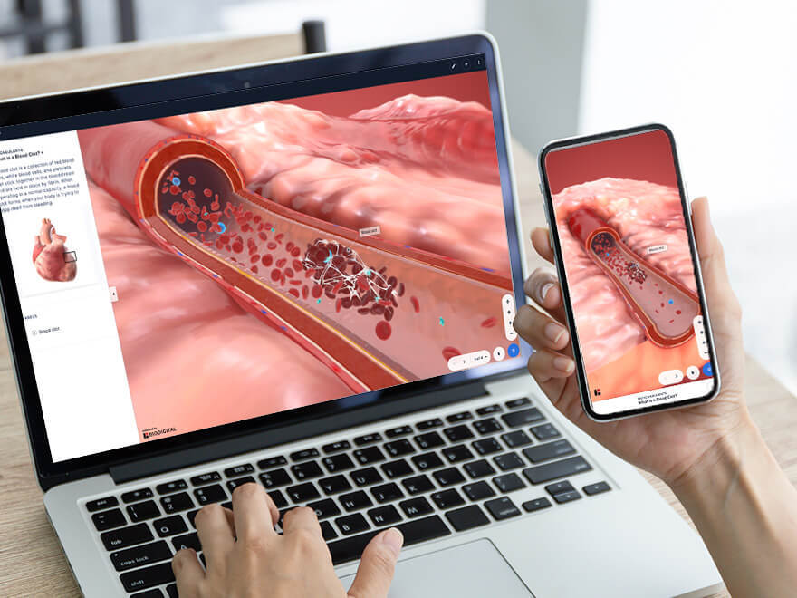 Using a 3D anatomy platform allows you to study conditions, like a blood clot, inside a virtual human body. title=